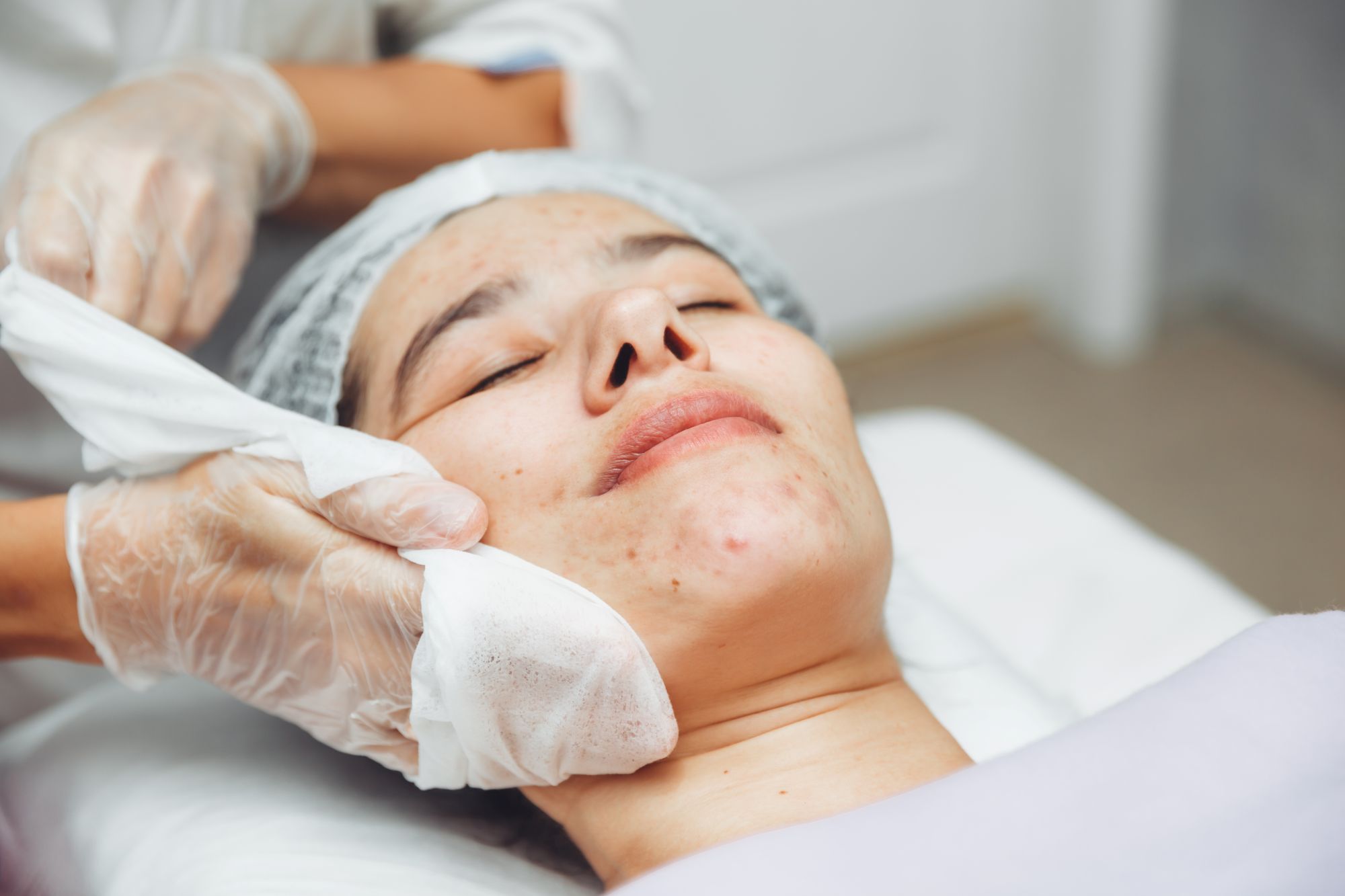 Acne Treatment Facial